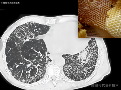 外泌體霧化可治療肺部結節及肺纖維化