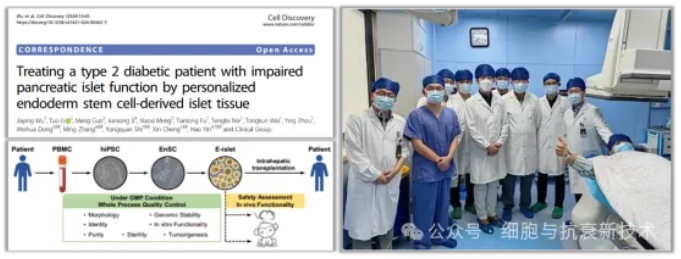 干細胞來源的自體再生胰島移植