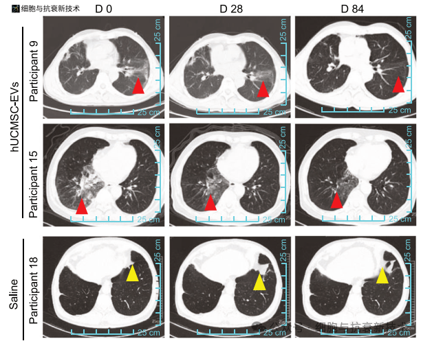 纖維化進(jìn)程逆轉(zhuǎn)